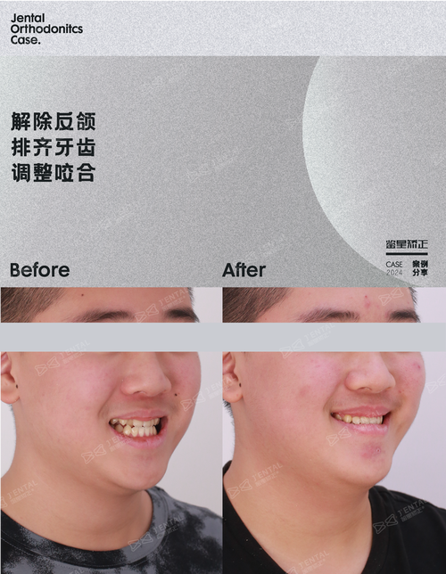 牙齿反颌矫正的最佳年龄到底是多少岁？-图3