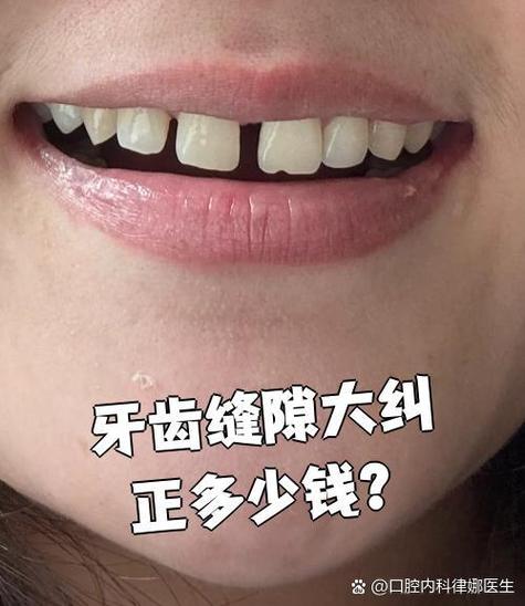 牙齿缝隙大矫正，整个矫正过程一般需要多长时间？-图3