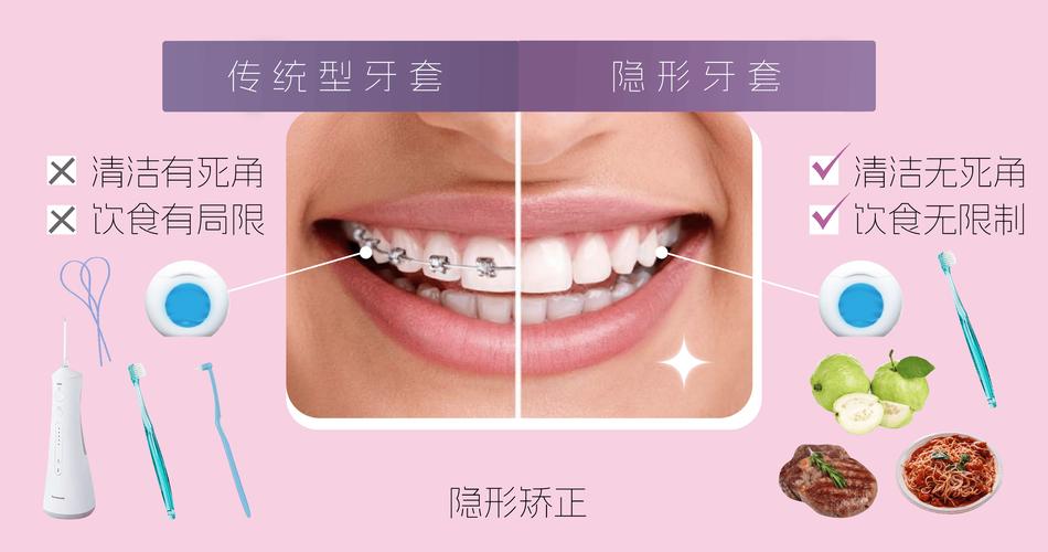 牙齿矫正带什么牙套好-图3