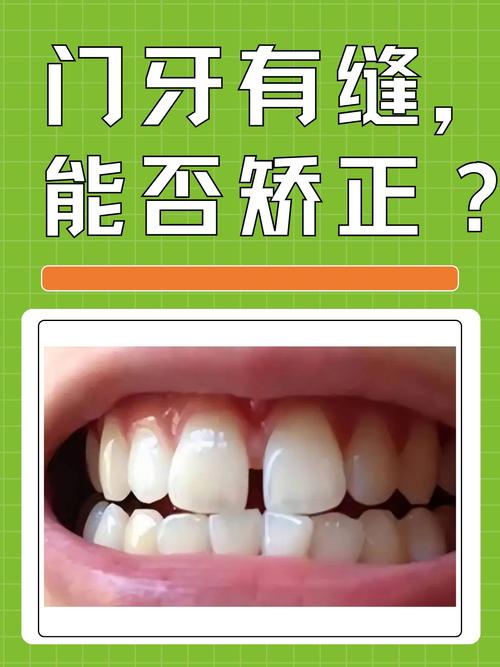 牙齿矫正中缝要对齐吗-图2