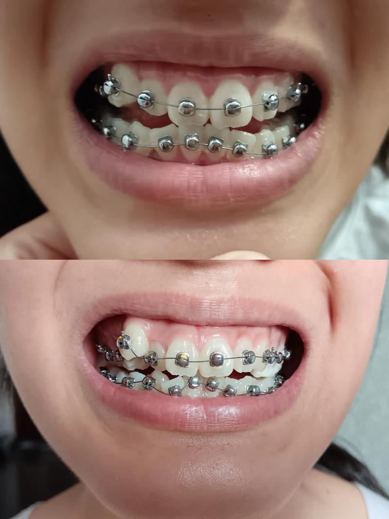 牙齿矫正几个月有变化-图3