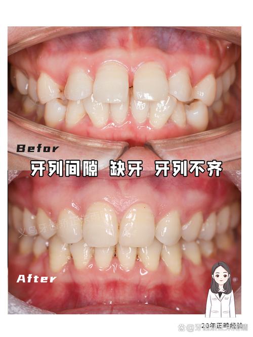20岁矫正牙齿,真的会有后遗症吗?-图2 20岁矫正牙齿,真的会有后遗症吗?-图2