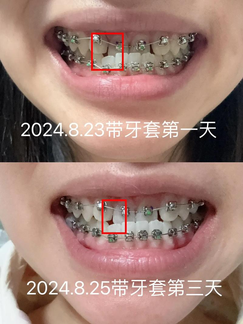 26岁能叫矫正牙齿么-图2