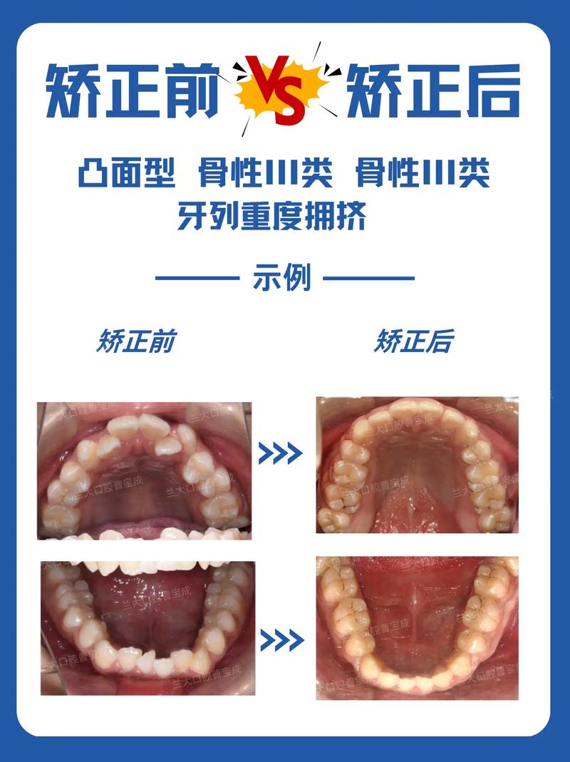 牙齿很不齐，能矫正吗？-图2