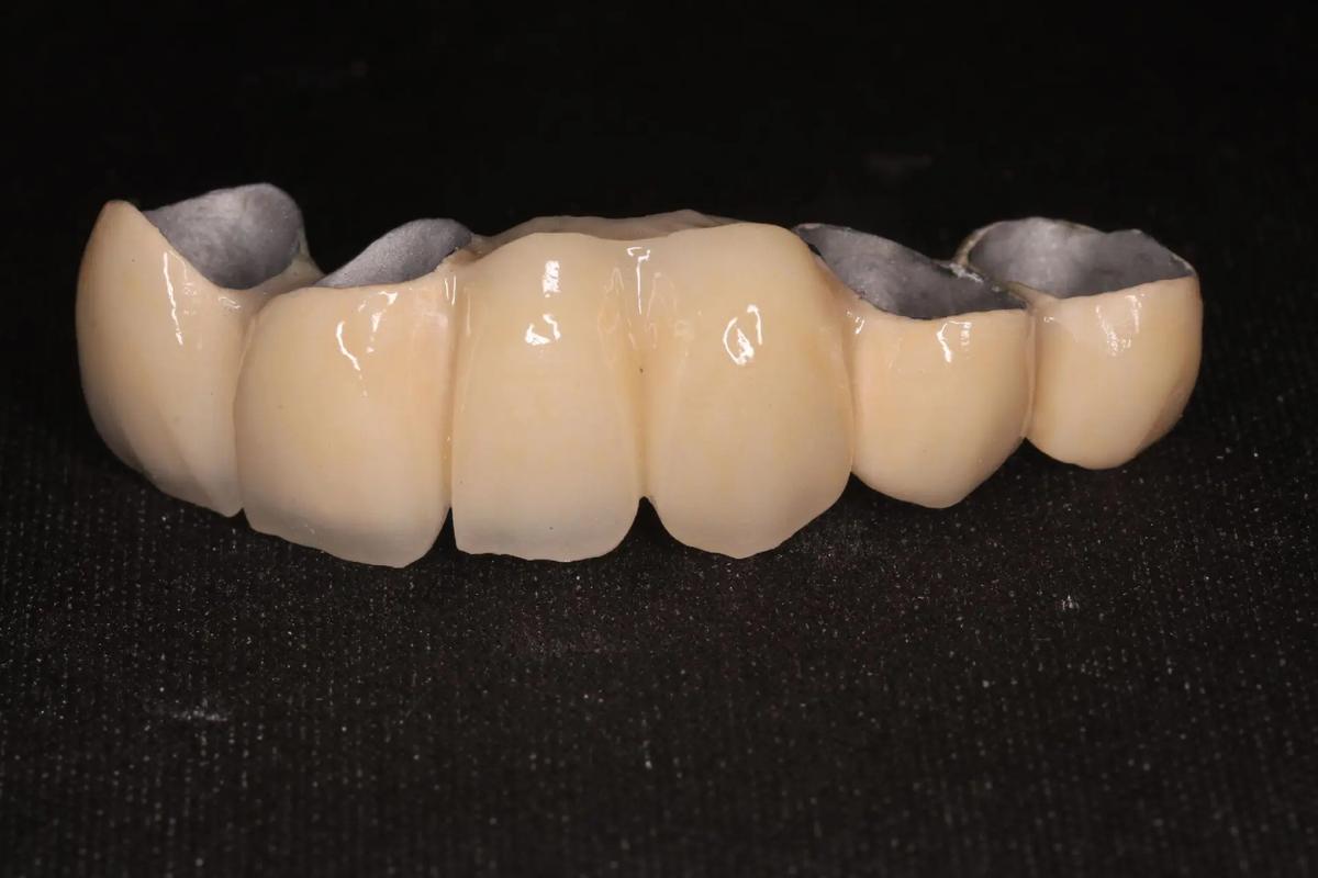 镶牙会影响牙齿矫正吗？能一起做正畸吗？-图2