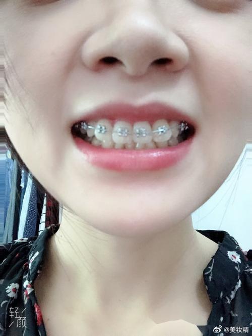 福州矫正牙齿贝臣权威-图1