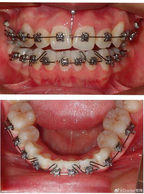 福州矫正牙齿贝臣权威-图3