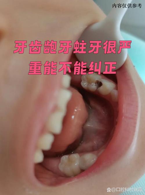 龋齿多还能矫正牙齿吗-图1