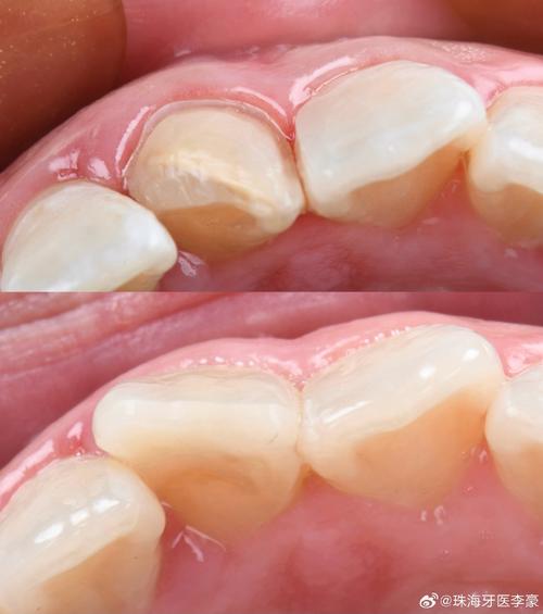 龋齿多还能矫正牙齿吗-图3