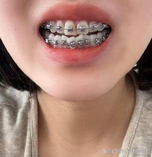 矫正牙齿反弹出现缝隙，是什么原因导致的？-图2