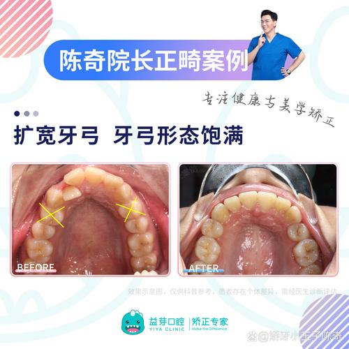 牙齿矫正拔牙需要两边对称吗？-图3