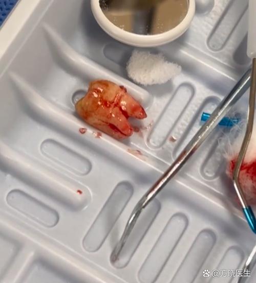 矫正牙齿智齿非拔不可吗？不用拔的情况存在吗？-图3