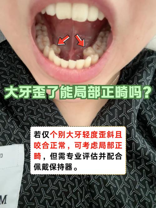 牙齿往里倾斜能矫正吗？-图2