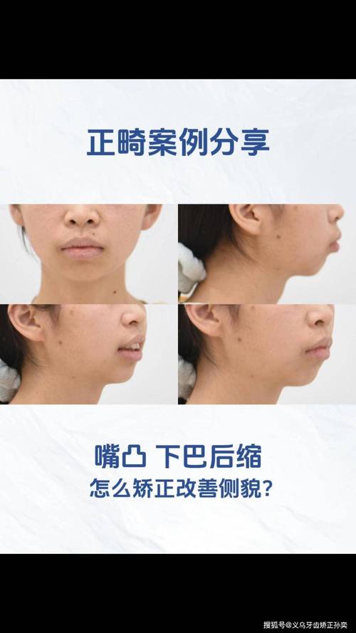 矫正牙齿会影响鼻子的形状或外观吗？-图3