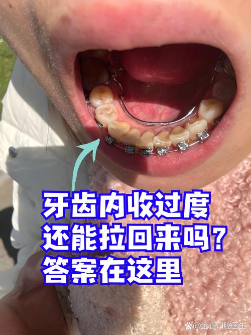 牙齿坏了还能矫正吗？-图3