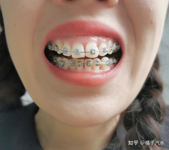 25岁牙齿矫正去哪里找靠谱机构？-图3