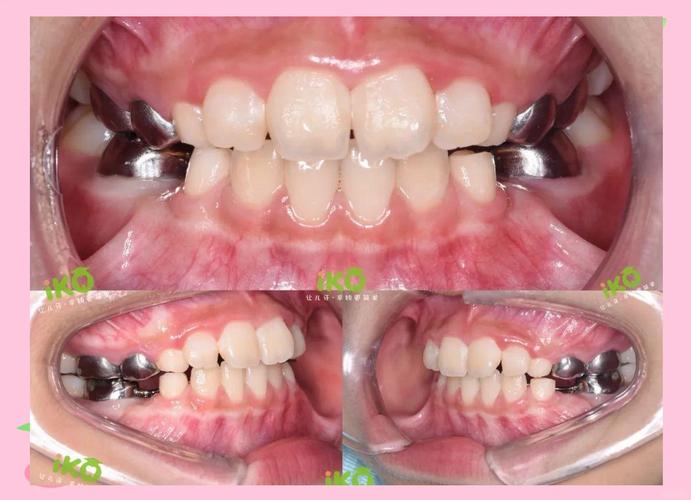 矫正牙齿后牙齿会活动吗？-图3