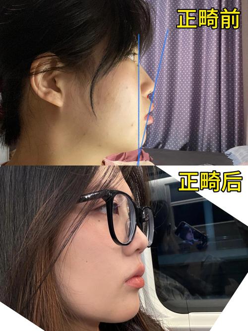 拔牙后矫正牙齿反弹了-图1 拔牙后矫正牙齿反弹了-图1