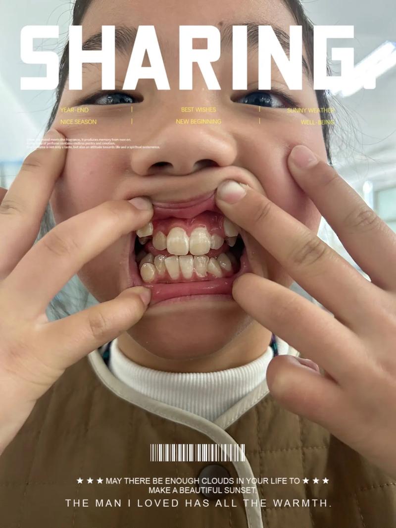 拔牙后矫正牙齿反弹了-图2 拔牙后矫正牙齿反弹了-图2