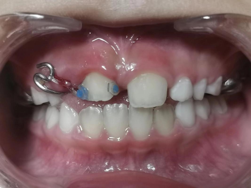 矫正牙齿晃动会掉吗？-图3