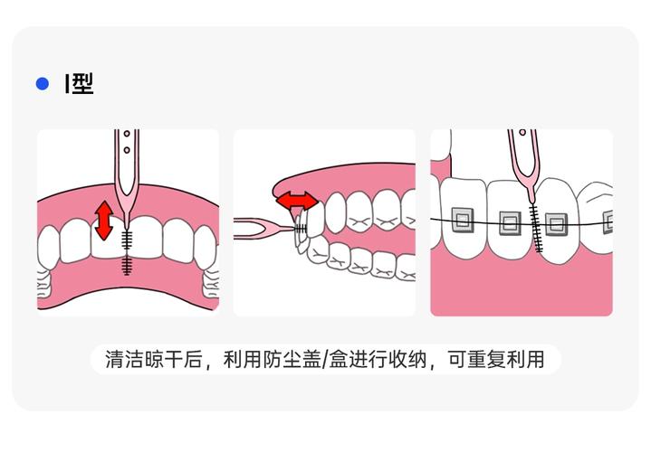 正畸矫正后，每天到底要刷几次牙？-图1