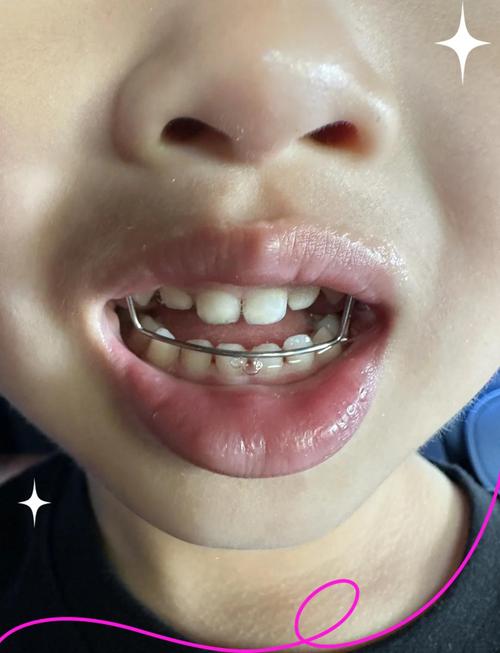 儿童牙齿反合矫正图片能看懂矫正效果吗？-图2