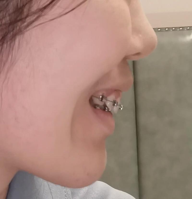 惠州致美口腔矫正牙齿效果如何？真的靠谱吗？-图3