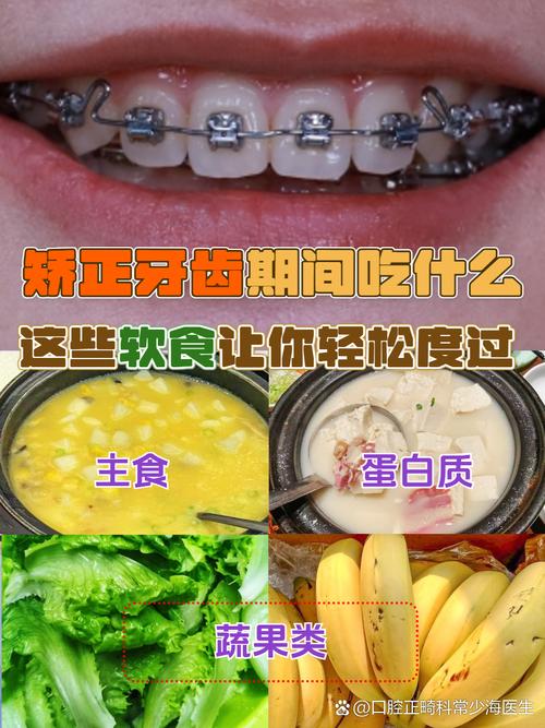 做矫正牙齿吃什么食物-图1 做矫正牙齿吃什么食物-图1