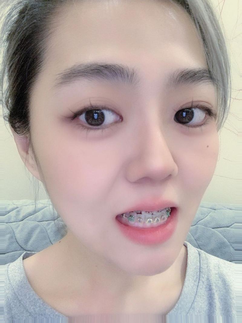 40岁还能牙齿矫正吗-图3