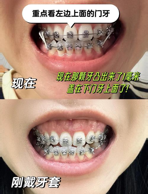 牙齿矫正后多久能看到明显变化?-图1 牙齿矫正后多久能看到明显变化?-图1
