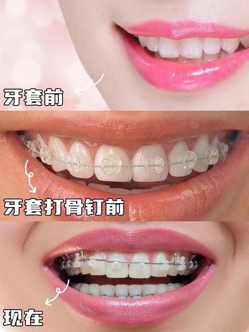 牙齿矫正后多久能看到明显变化?-图3 牙齿矫正后多久能看到明显变化?-图3