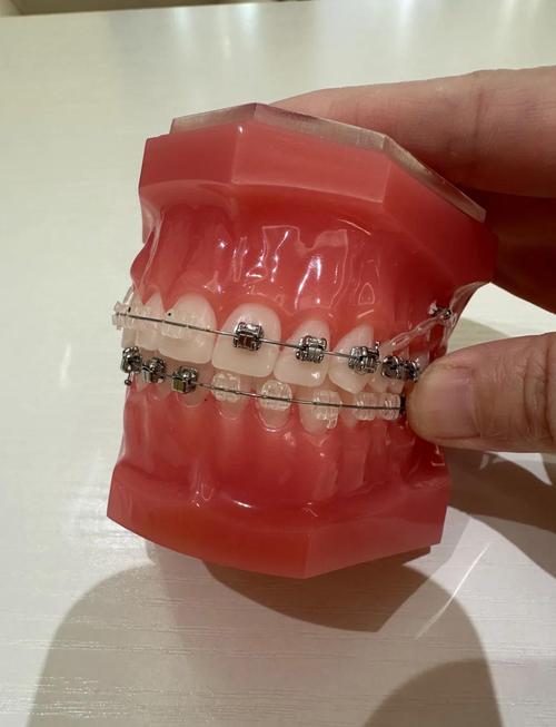 隐形牙套矫正牙齿的过程是怎样的?-图2 隐形牙套矫正牙齿的过程是怎样的?-图2
