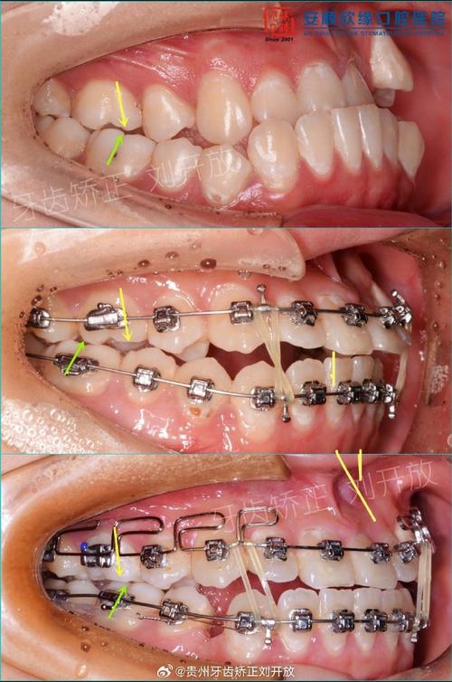 贵阳牙齿矫正哪家好？如何选对靠谱的矫正机构？-图1