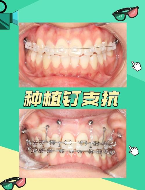 矫正牙齿打钉子带多久-图1