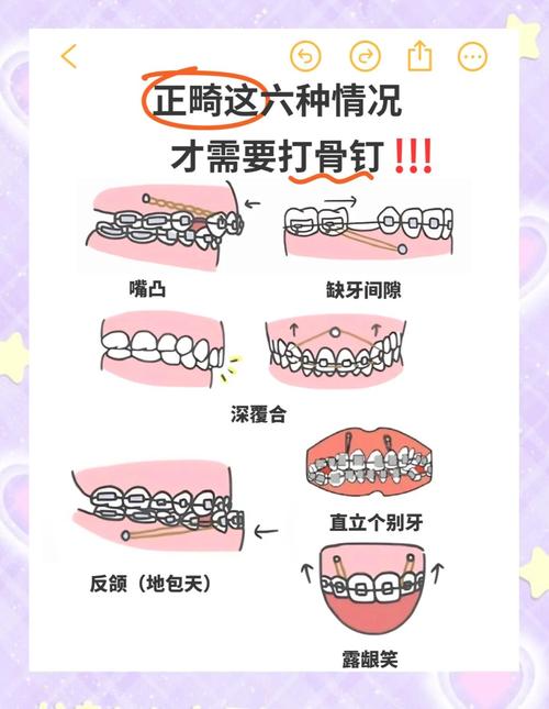 矫正牙齿打钉子带多久-图2