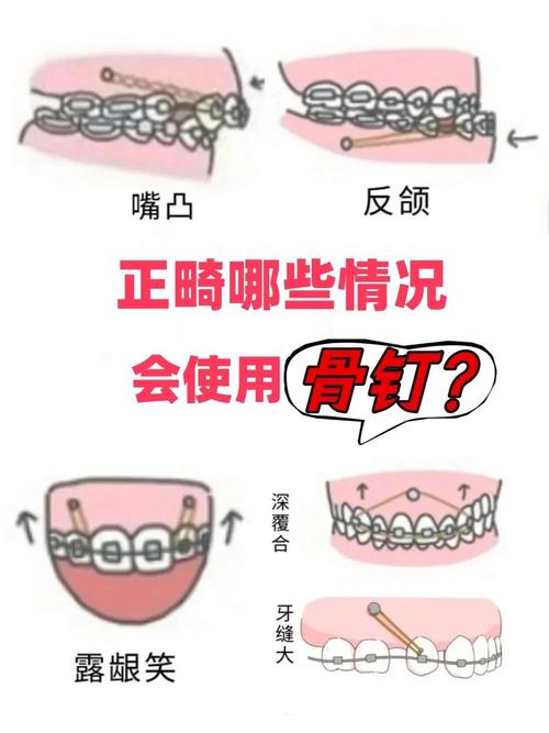 矫正牙齿打钉子带多久-图3