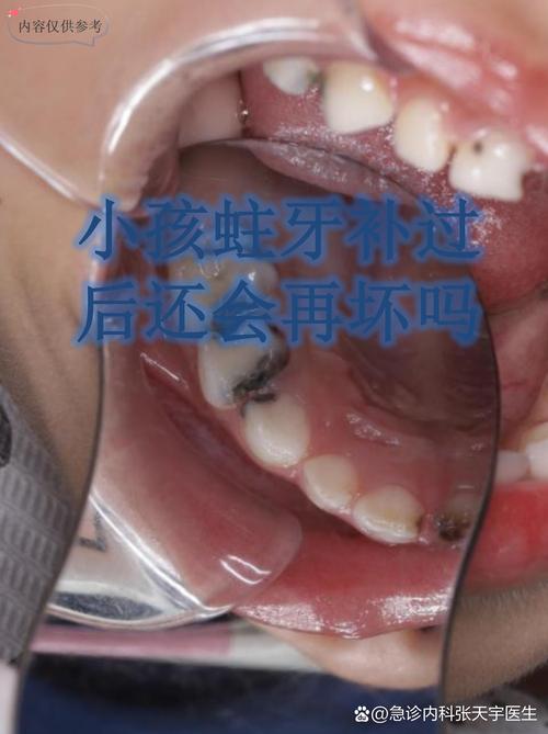 矫正牙齿期间，拔掉蛀牙可以吗？需要拔除吗？-图3