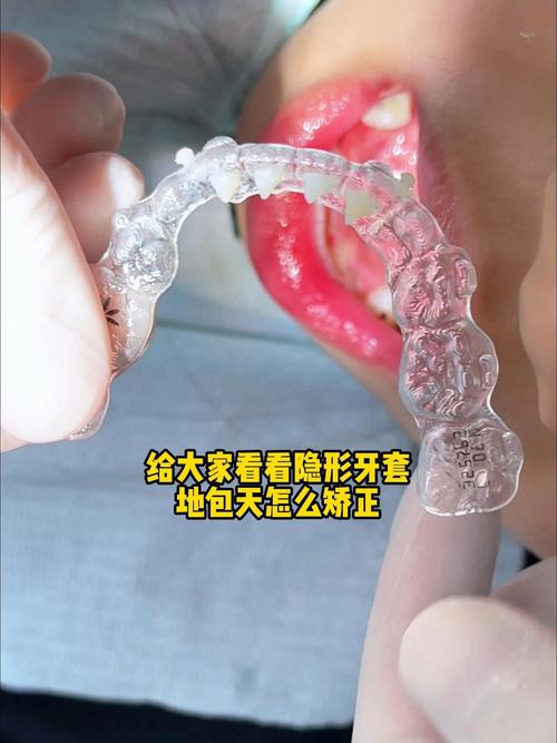 婴儿地包天需要矫正吗？矫正的最佳时机是什么时候？-图3