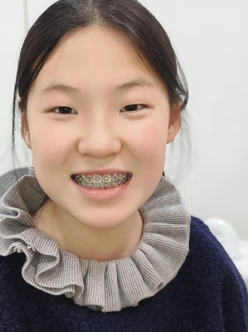矫正牙齿戴牙套，一般需要戴几年？-图2
