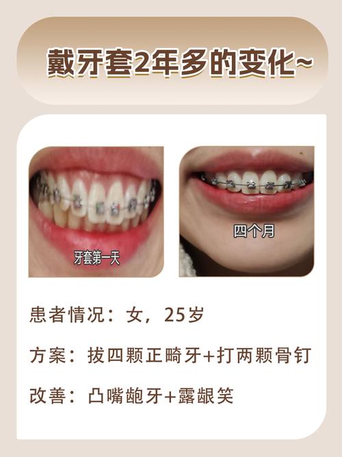 矫正牙齿戴牙套，一般需要戴几年？-图3