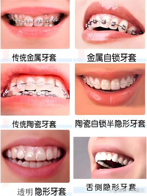 矫正牙齿哪里便宜又好？求性价比高又靠谱的推荐！-图3