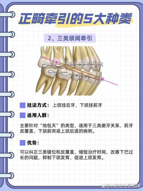 矫正牙齿橡皮链的作用究竟是什么？-图2