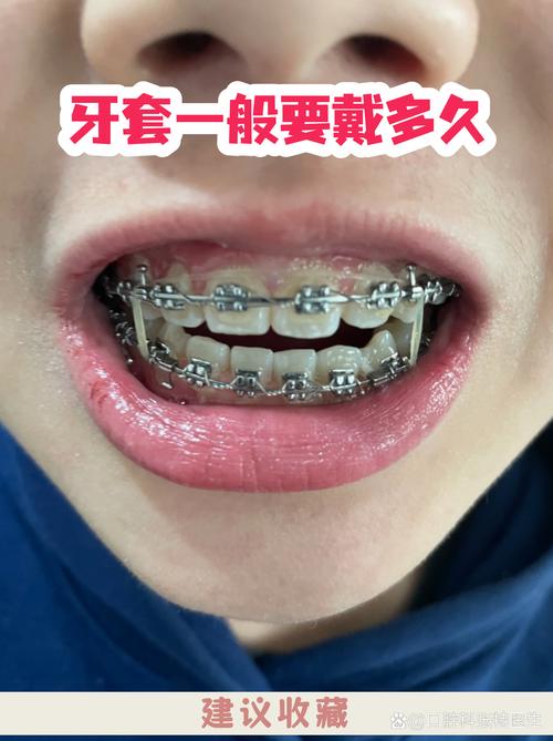 为什么矫正牙齿能让牙齿移动？背后的机制是什么？-图2