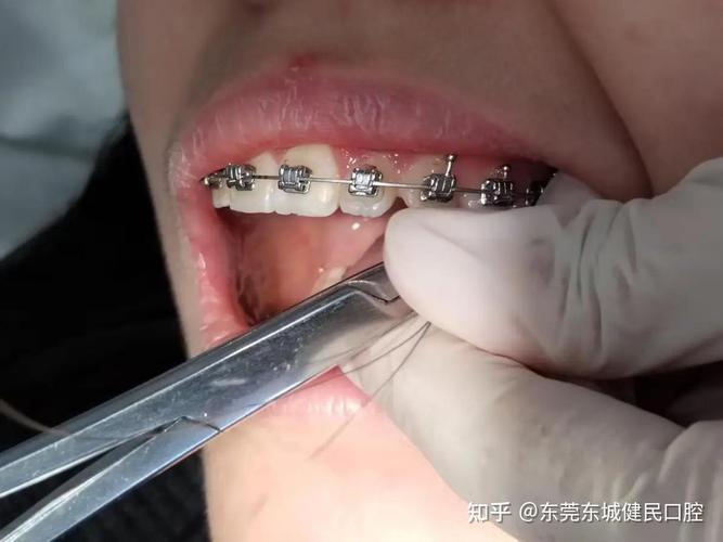 东莞牙齿矫正怎么选最正规?靠谱机构有哪些判断方法?-图3 东莞牙齿矫正怎么选最正规?靠谱机构有哪些判断方法?-图3