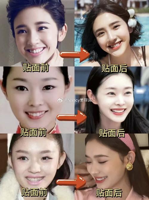 明星矫正牙齿的方法有哪些？-图1