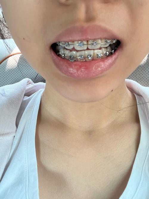 青岛口腔医院矫正牙齿效果如何？价格贵不贵？靠谱吗？-图2