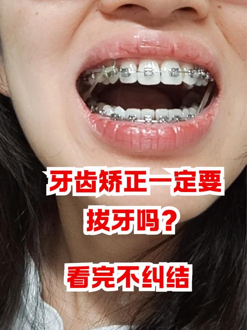 矫正牙齿带多久有效果-图3