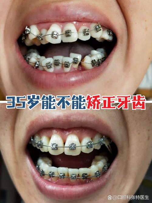 年龄大了矫正牙齿还来得及吗?-图2 年龄大了矫正牙齿还来得及吗?-图2