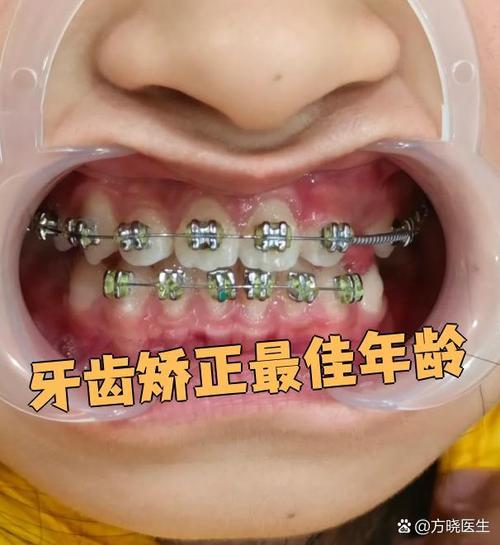 年龄大了矫正牙齿还来得及吗?-图3 年龄大了矫正牙齿还来得及吗?-图3