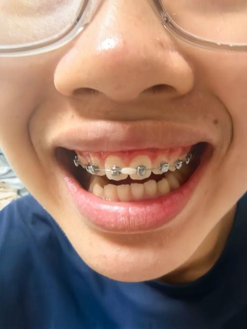 矫正牙齿可以换医院吗-图3